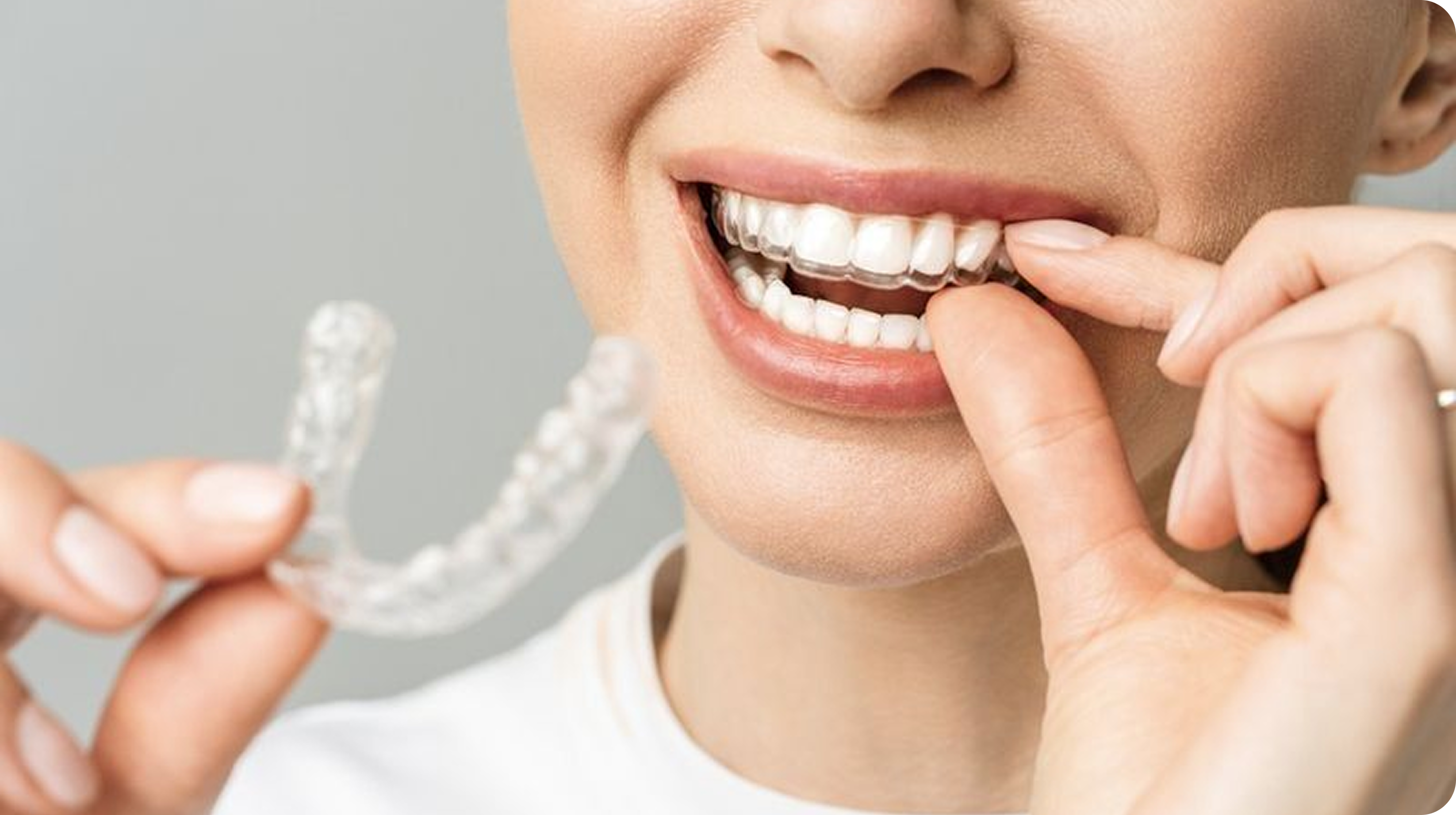 인비절라인 케이스